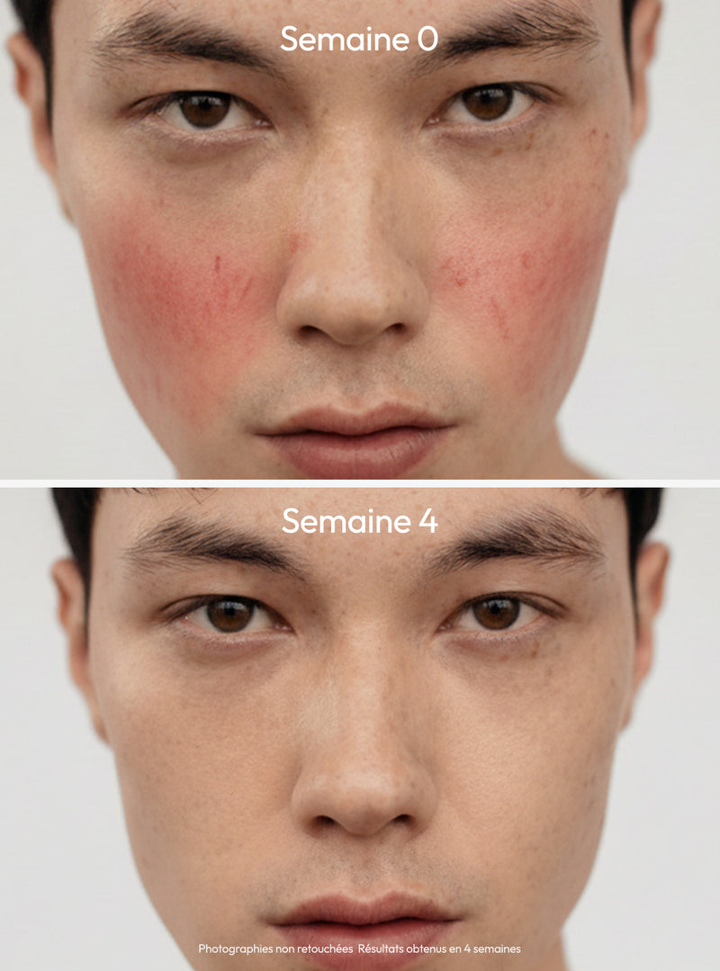 Kit Routine Anti-rougeurs — vue 2