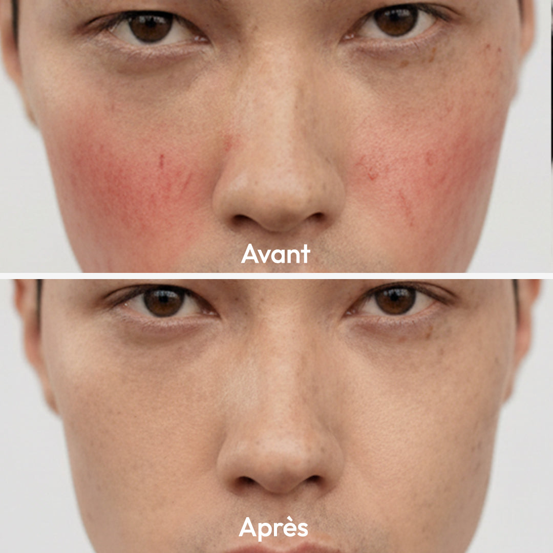 Masque Stick Anti-Rougeurs